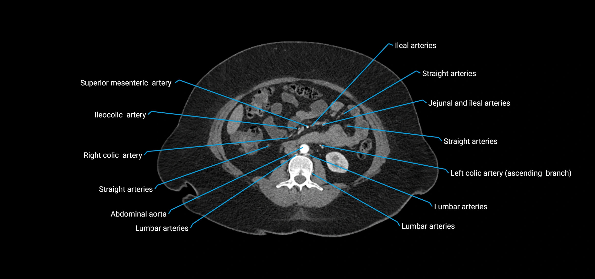 CTA abdomen axial cross sectional anatomy labelled image_97 (2).webp